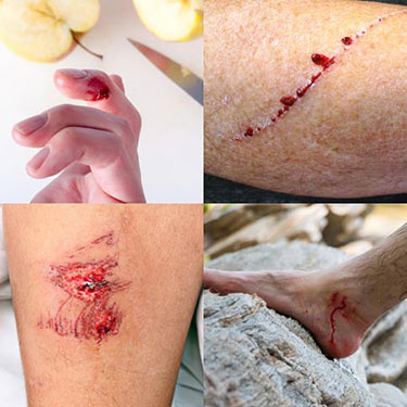 First, apply pressure!